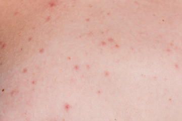 Fototapeta premium Acne on the skin - medical, cosmetic background, the concept of skin cleansing
