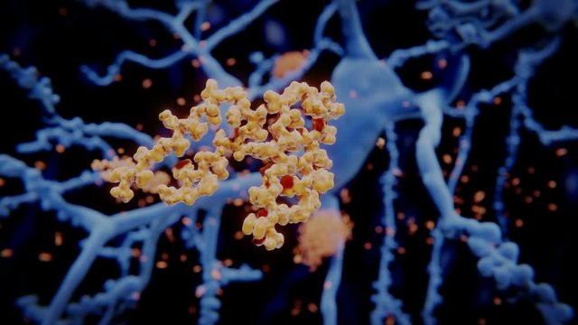 Alzheimer: Freie Amyloid-beta-Peptide lagern sich zu Amyloid-Plaques ab. 