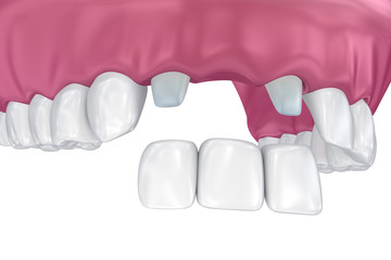 Tooth supported fixed bridge. Medically accurate 3D illustration