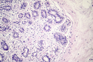 Hard breast cancer, light micrograph, photo under microscope