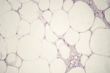 Lipoma, benign growth of fatty tissue, light micrograph, photo under microscope