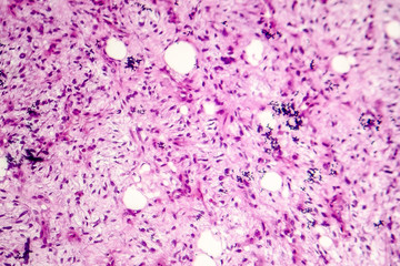 Liposarcoma, soft tissue sarcoma, light micrograph, photo under microscope