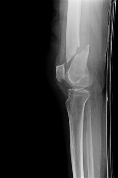 knee with total replacement x-ray image on black background