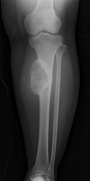 knee with total replacement x-ray image on black background