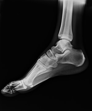 human foot ankel and leg x-ray picture