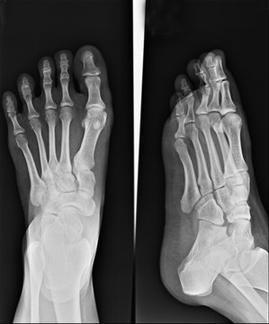 human foot ankel and leg x-ray picture