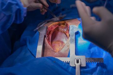 Doctors team wear blue coat perform heart surgery at the operating room in the hospital.