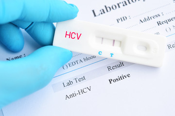 Hepatitis C virus positive test result by using rapid test cassette