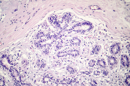 Hard breast cancer, light micrograph, photo under microscope