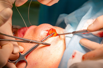 Plastic surgery in operating room. Circular face lift