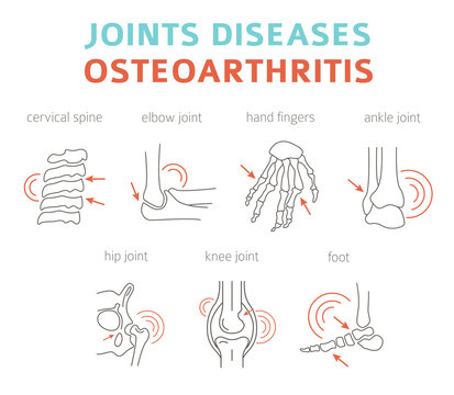 Joints diseases. Arthritis, osteoarthritis symptoms, treatment icon set. Medical infographic design