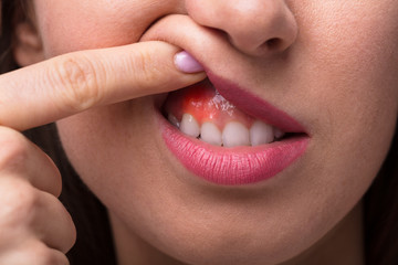 Woman Showing Swelling Of Her Gum