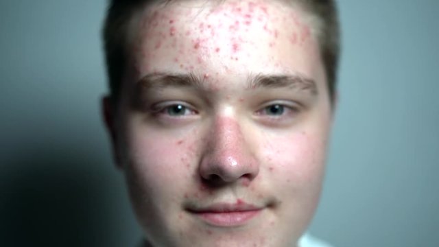 Young man with dermatology skin problems looking at the camera in the studio on the grey background. Close up.