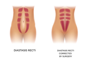 Diastasis Recti also known as Diastasis Rectus Abdominis or abdominal separation, it is common among pregnant women and post birth. Before and after surgery correction. 