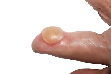 Burns on finger