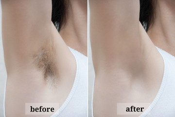 Depilation zone underarms. Before and after.