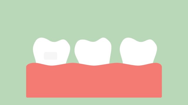 orthodontic teeth or dental braces - dental cartoon vector flat style render 2d animation in 4K
