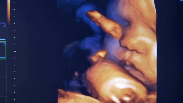 Live image of a fetus on a sonography monitor. Real image of a unborn in the womb.