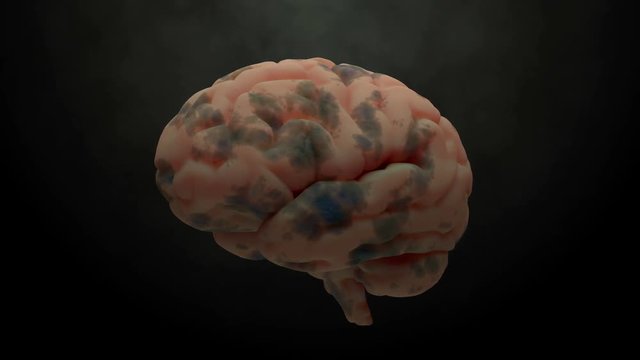 3d render of brain with damage zones. Infection or another reason of brain damage concept. Animation of growing brain damage zone.