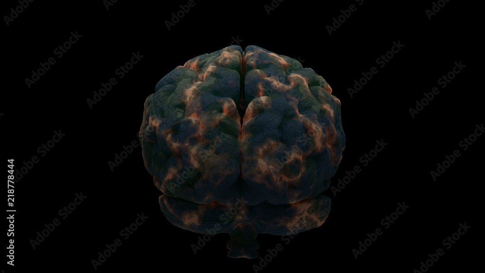 Aufkleber 3d render of brain with damage zones. infection or another reason of brain damage concept. isolated 