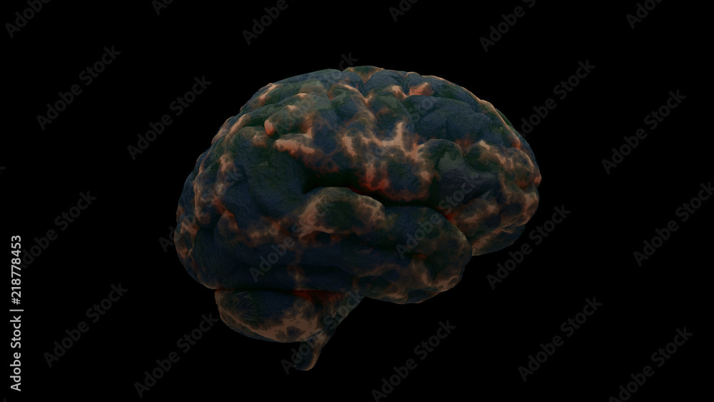 Aufkleber 3d render of brain with damage zones. infection or another reason of brain damage concept. isolated 