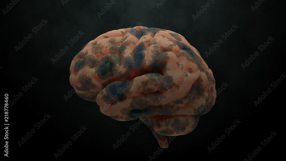 Aufkleber 3d render of brain with damage zones. infection or another reason of brain damage concept.