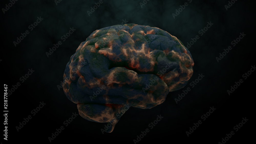 Aufkleber 3d render of brain with damage zones. infection or another reason of brain damage concept.