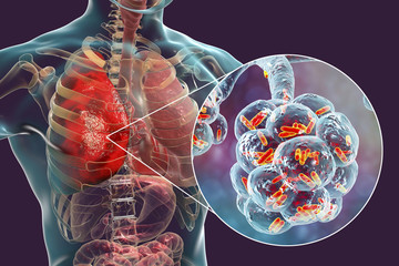 Bacterial pneumonia, medical concept. 3D illustration showing rod-shaped bacteria inside alveoli of the lung