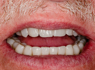 vollkeramische restauration, zirkonoxid, zahnkronen