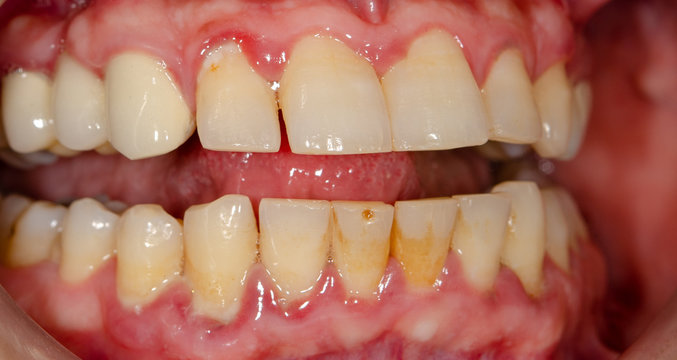 gingivitis, zahnstein, bakterieller belag