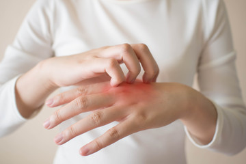 Young woman scratching the itch on her hands w/ redness rash. Cause of itchy skin include dermatitis (eczema), dry skin, burned, food/drugs allergies, insect bites. Health care concept. Close up. - obrazy, fototapety, plakaty