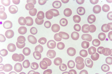 Target cells with abnormal red blood cells from anemia patient, analyze by microscope
