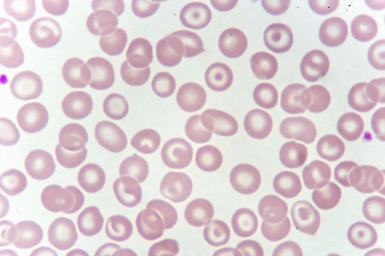 Target cells with abnormal red blood cells from anemia patient, analyze by microscope
