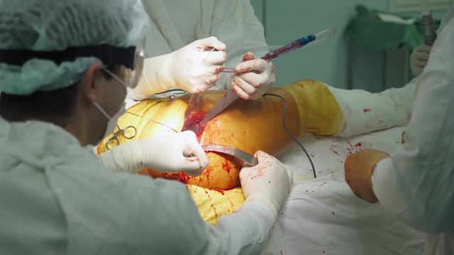 Hospital, surgery operation on the leg, surgeons at work.
