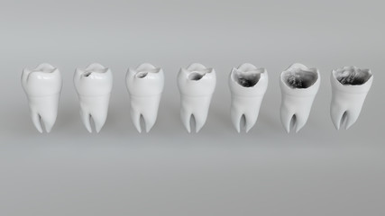 The stages of caries on the molar - 3D Rendering