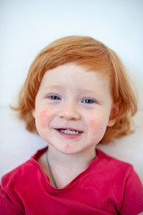 A child with signs of an allergy on the face