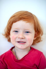 Fototapeta premium A child with signs of an allergy on the face