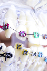 Dental metal brace teeth model