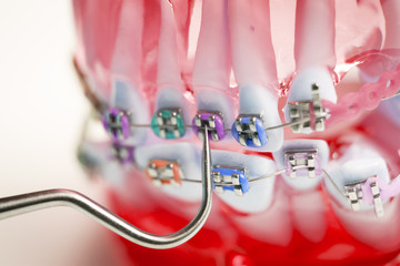 Dental metal brace teeth model