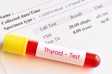 Blood sample tube with abnormal thyroid hormone test result 