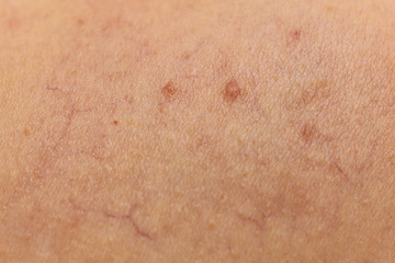 Fototapeta premium Ski with dilated capillaries ad red spots