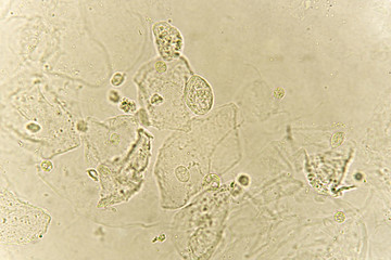 Epithelial cells with bacteria in patient urine (urinary tract infections), analyze by microscope
