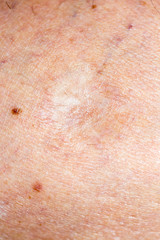 Fototapeta premium Wound on the skin of a macro