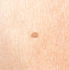 Moles and various skin conditions macro