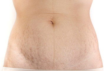 Abdominal scar marked pattern