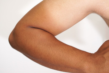 Arm two tone skin sunburn