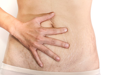Abdominal scar marked pattern