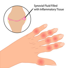 Rheumatoid arthritis on fingers medical vector illustration