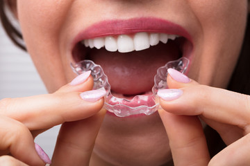 Woman Putting Transparent Aligner In Teeth