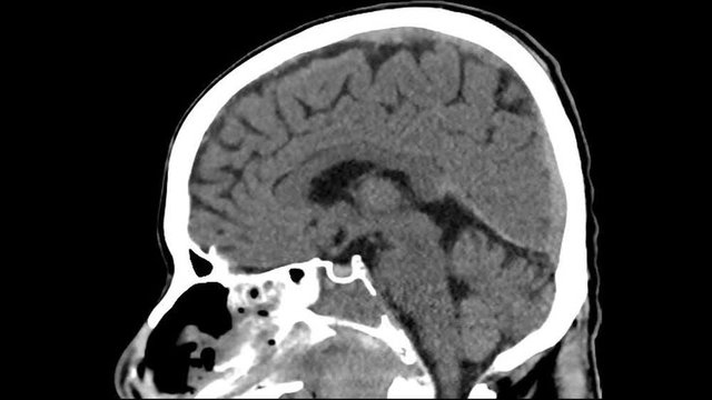 Ct Brain with of Throat cancer. Side view